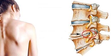 Il meccanismo di sviluppo dell'osteocondosi cervicale