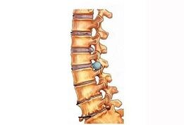 Stadi di sviluppo dell'osteocondosi di cervice