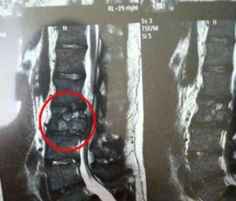 Il tumore della sala vertebrale nella foto