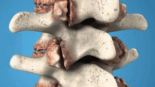 Osteofiti di vertebre - crescita patologica che danneggiano i nervi e i vasi sanguigni