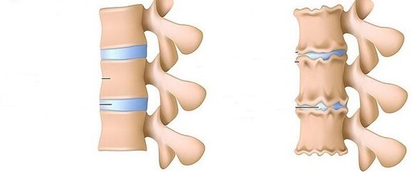 Colonna vertebrale sana e osteocondosi