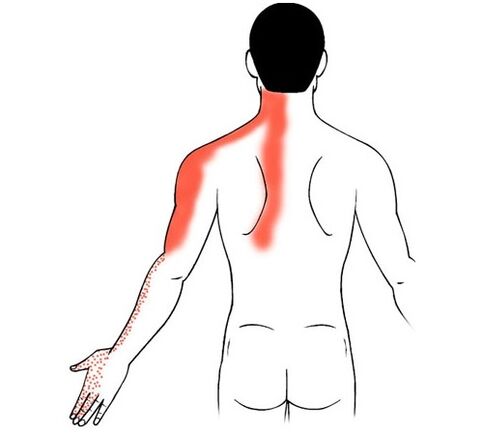 osteocondrosi cervicale come causa di dolore alle articolazioni delle dita