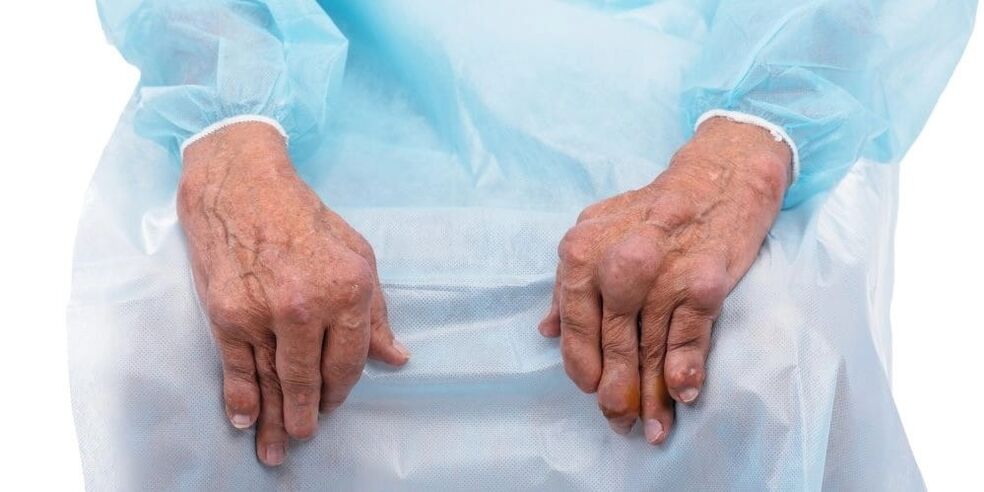 L'artrite infettiva è una malattia caratterizzata da dolore costante e alterazioni delle articolazioni delle dita.