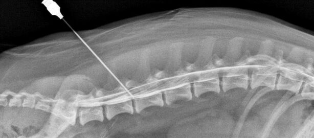 Blocco della colonna vertebrale con osteocondrosi