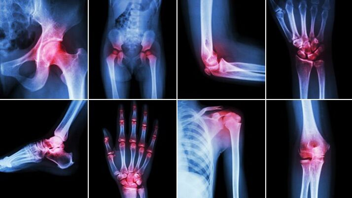 Articolazioni del corpo colpite da osteoartrite